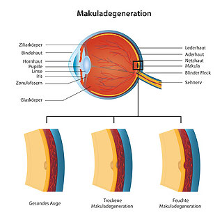 Makuladegeneration